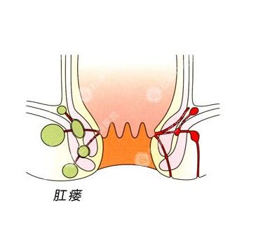 混合痔肛瘘咋办?安氏疗法见效快!